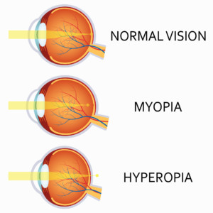 normal vision vs myopia vs hyperopia