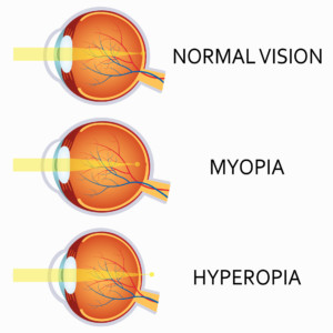 Astigmatism Measurement Chart