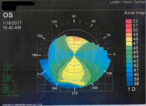 eye topography