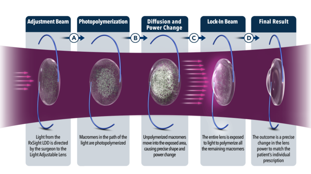 Light Adjustable Lenses