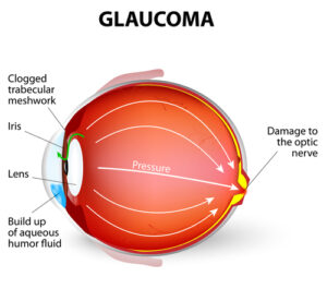 glaucoma diagram