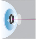 Illustration of a Laser Going Into an Eye During Cataract Surgery